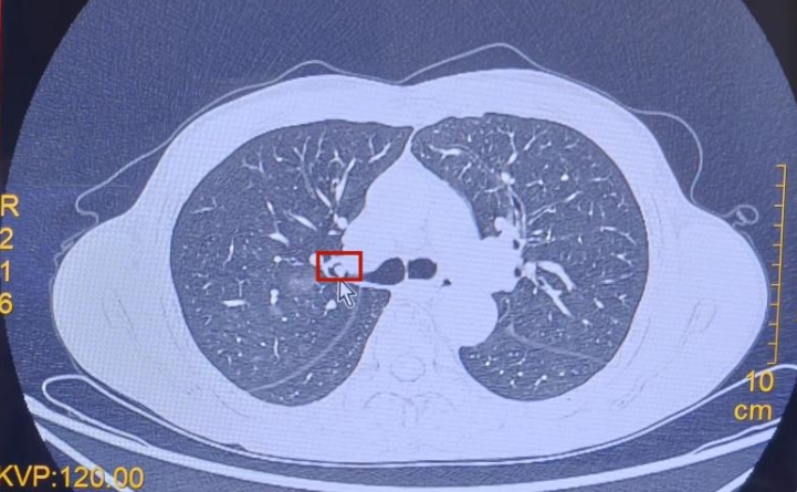 【新快报】3毫米肺结节揪出罕见病中的罕见病