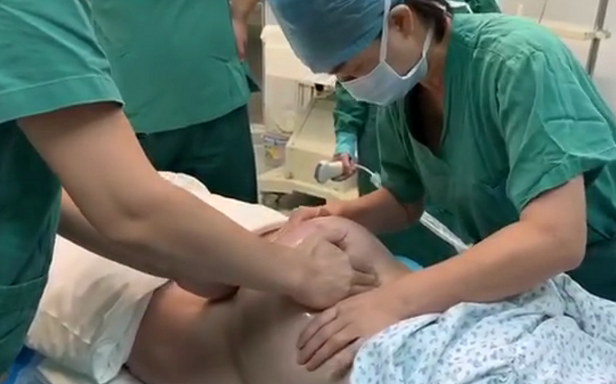 【南方网】神奇！1分钟剖腹变顺产！“外倒转术”帮臀位产妇免挨一刀