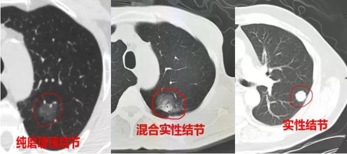 OMG!体检查出肺结节就是要得肺癌了吗？