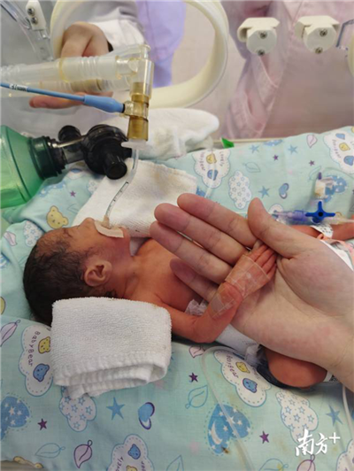 【南方日报】血管细如丝，不足2斤早产儿连闯“生死关”